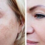 Laser Pigmentation Removal Daytona Beach/Laser Treatment For Wrinkles Daytona Beach