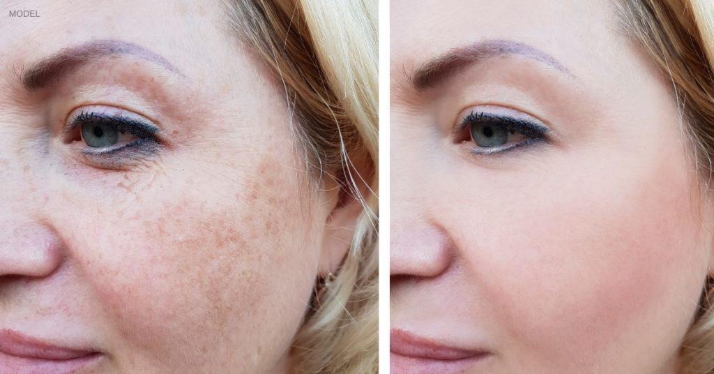 Laser Pigmentation Removal Daytona Beach/Laser Treatment For Wrinkles Daytona Beach