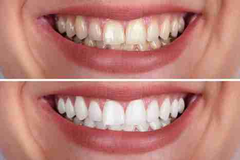 Teeth Whitening Cardiff