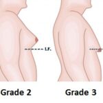 Breast Augmentation in Islamabad