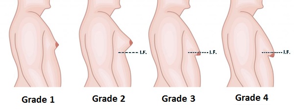 Breast Augmentation in Islamabad