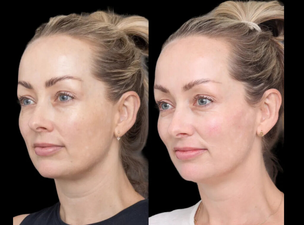 fillers in dubai