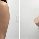 breast lift in dubai