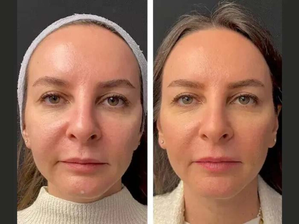 Mesotherapy IN DUBAI