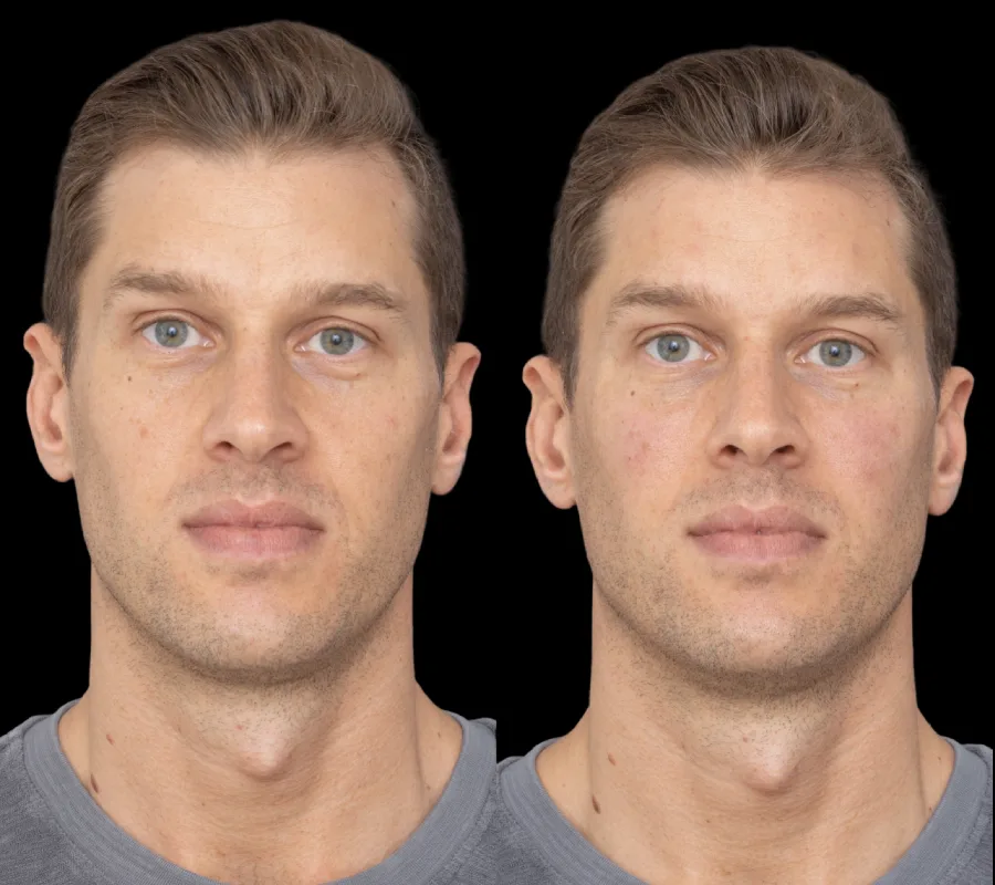 under eye fillers in dubai