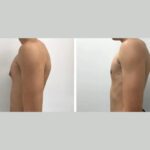 gynecomastia in dubai