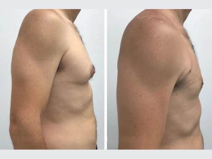 gyencomastia in dubai