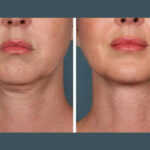 PRP Treatment in Dubai
