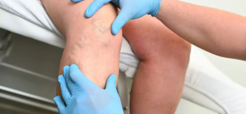 Vein Center Near Me