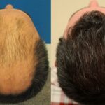 hair transpalnt in islamabad pakistan