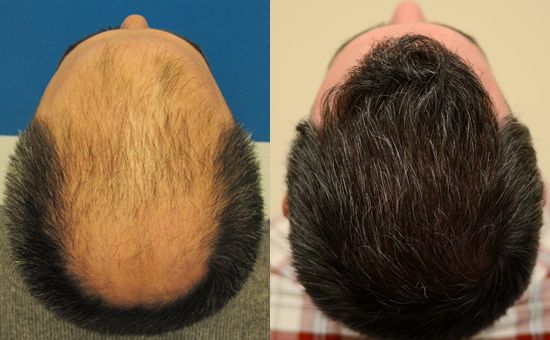 hair transpalnt in islamabad pakistan