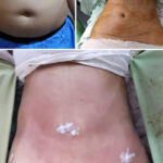 laser fat removal in pakistan