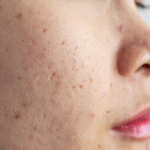 Clear, Confident Skin: Professional Acne Treatment in Beverly Hills