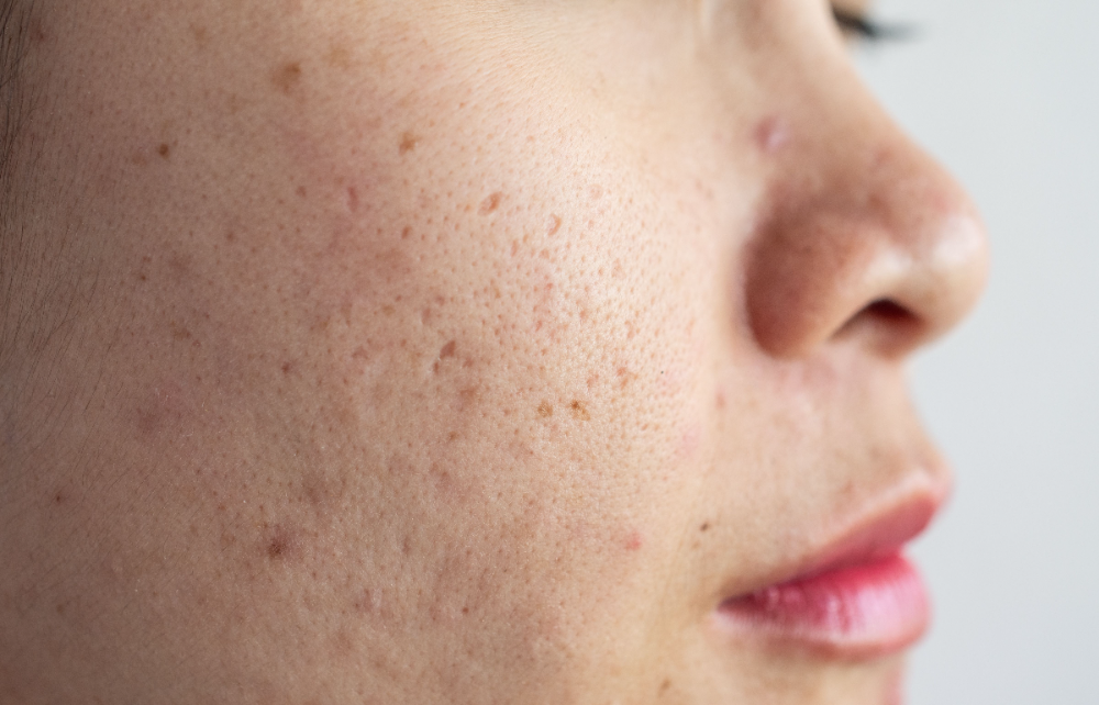 Clear, Confident Skin: Professional Acne Treatment in Beverly Hills