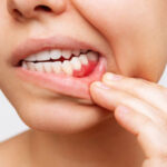 Gum Disease