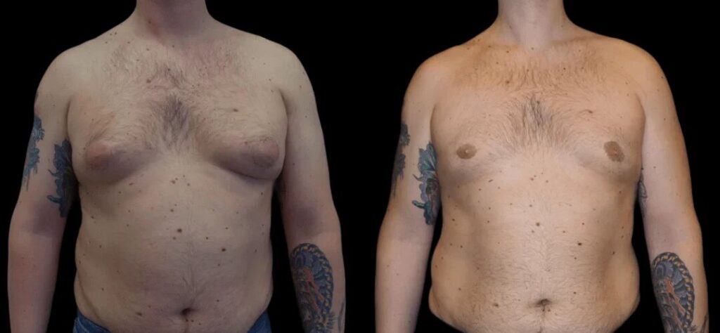 Pre- and Post-Care Tips from the Best Gynecomastia Surgeons in dubai