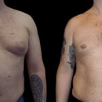 Pre- and Post-Care Tips from the Best Gynecomastia Surgeons in dubai