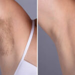 Laser hair removal in Dubai