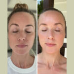 From Sagging to Stunning: Fotona 4D Laser in Dubai Results