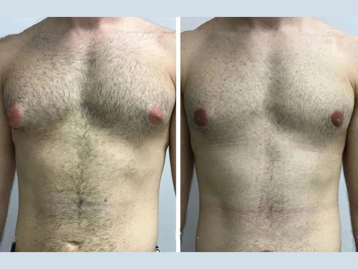 Affordable Gynecomastia Surgery in Dubai for Every Budget