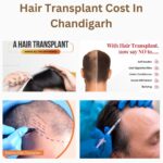hair transplant cost in Chandigarh