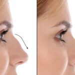 Rhinoplasty in Dubai