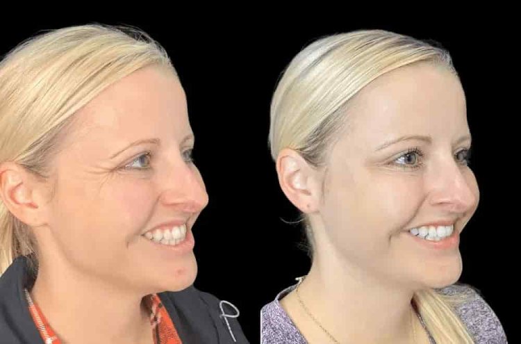 Discover Precision and Artistry with the Best Plastic Surgeons in Dubai for Botox