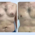 Best Post-Surgery Skincare Tips After Gynecomastia Surgery in Dubai