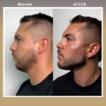 jaw surgery