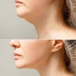 jaw surgery
