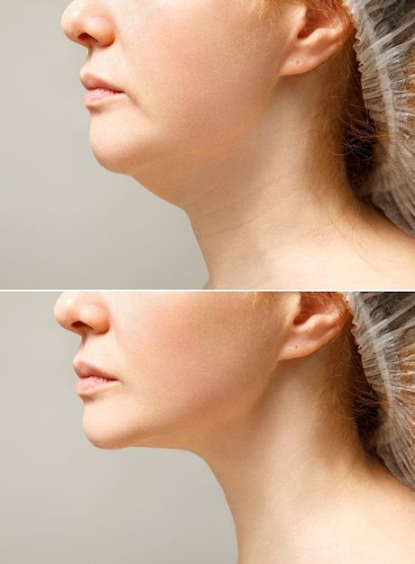 jaw surgery
