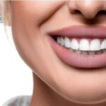 Hollywood Smile in Dubai
