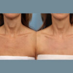 Moxi Laser Treatment