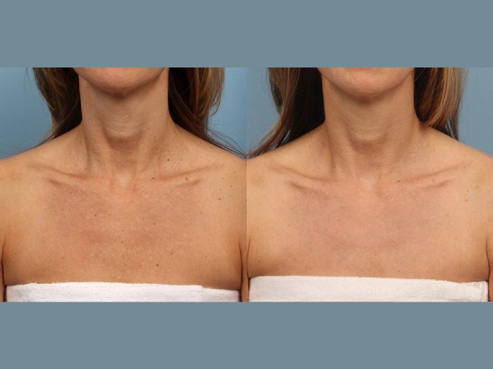 Moxi Laser Treatment