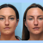 The Art of Facial Sculpting by the Best Plastic Surgeons in Dubai for Thread Lift
