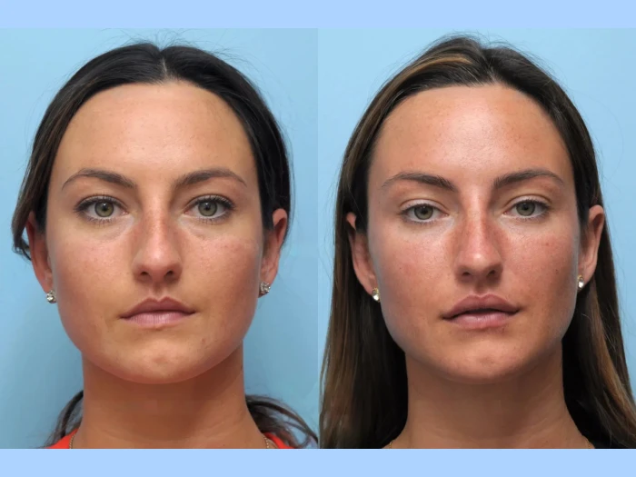 The Art of Facial Sculpting by the Best Plastic Surgeons in Dubai for Thread Lift
