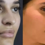 best rhinoplasty surgeon in dubai