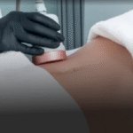HD Liposuction in Dubai