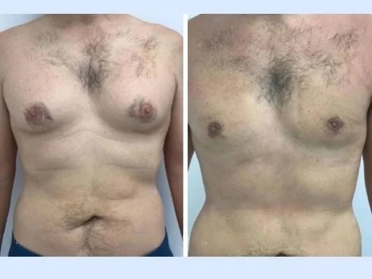 How Excess Tissue Is Removed During Gynecomastia in Dubai Surgery