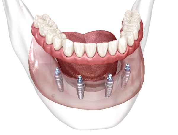 Dental Implant Bristol