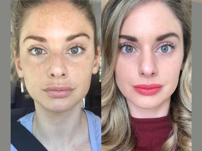 How the Best Aesthetic Clinic in Dubai Radiofrequency (RF) Microneedling Enhances Skin Texture