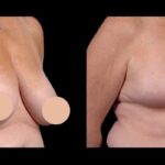 Cost Factors Explained by Best Doctors in Dubai for Breast Reduction in Dubai