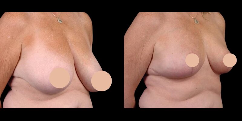 Cost Factors Explained by Best Doctors in Dubai for Breast Reduction in Dubai
