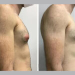 Achieve a Sculpted Chest with Gynecomastia Surgery in Dubai