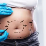 abdominoplasty in islamabad
