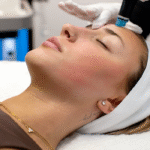 chemical peel treatment in Islamabad