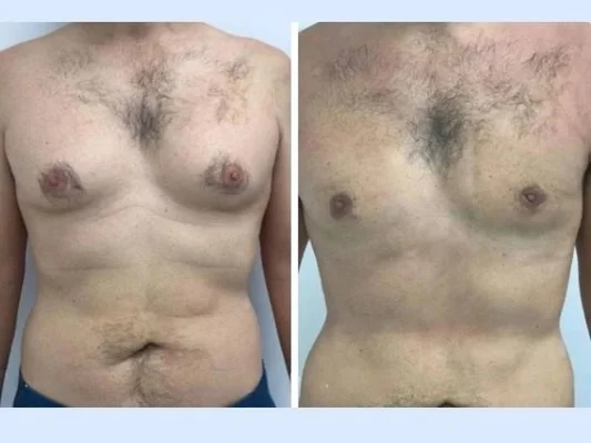Why Global Patients Travel to Meet the Best Gynecomastia Surgeon in Dubai