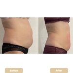 liposuction in islamabad